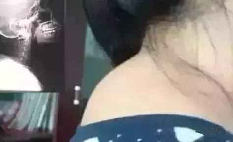 几个化解脖子上富贵包的方法 养生之道 第1张
