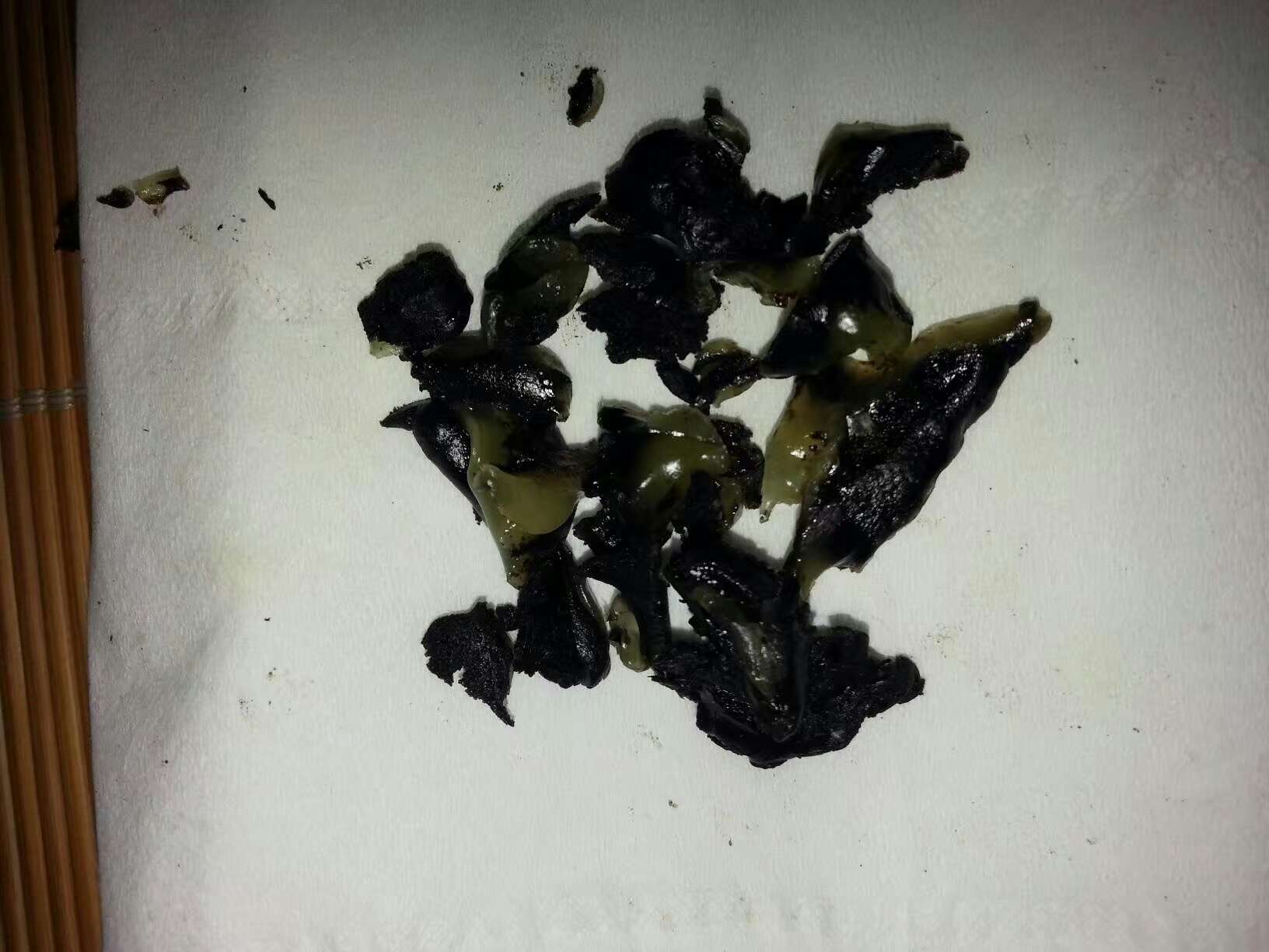 泥疗膏拔出的实例图解 DDS生物电手册 第1张