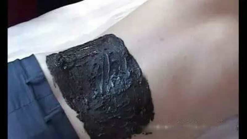 泥疗膏拔出的实例图解 DDS生物电手册 第13张